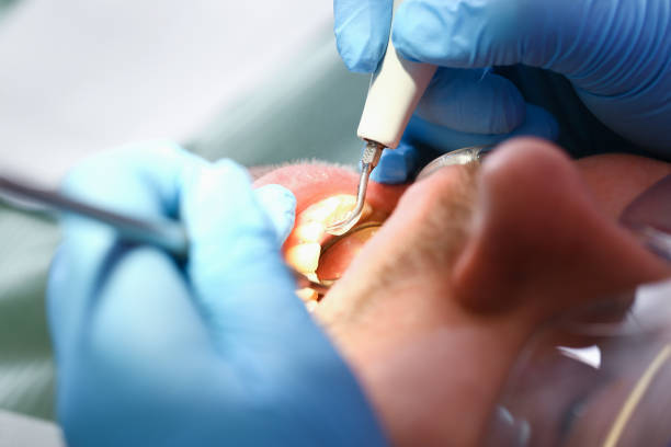 Best Emergency Tooth Extraction in Chocowinity, NC